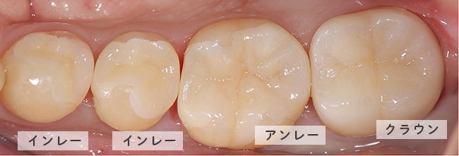 セラミックの症例写真