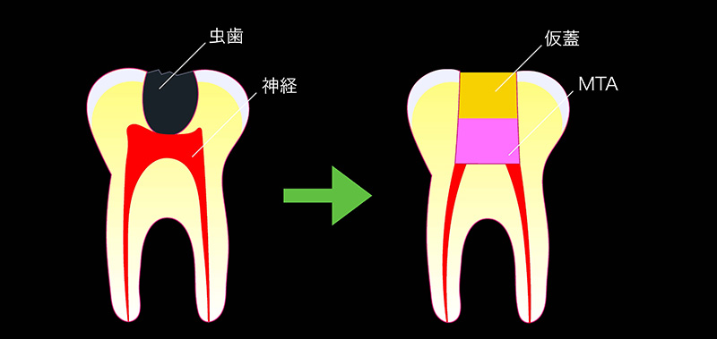 断髄治療