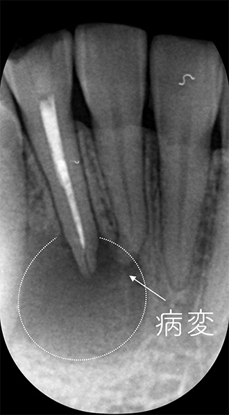 根管治療 難症例