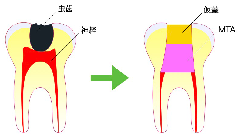 歯の神経を残す治療法