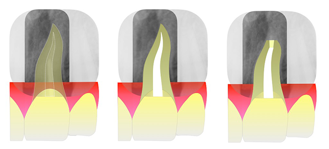 根切治療